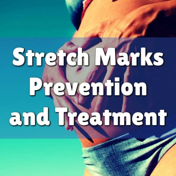 Stretch Marks Prevention and Treatment: Embrace Beautiful Skin!